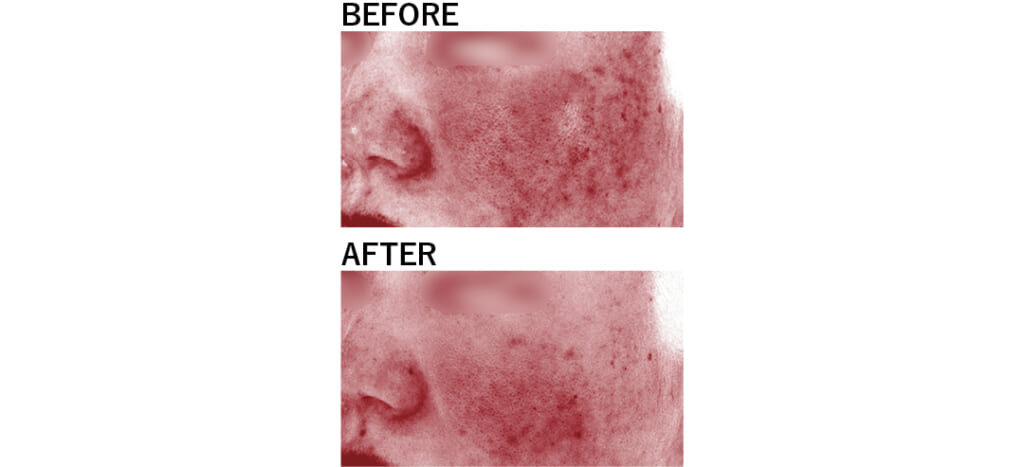 ニキビ治療Before／After