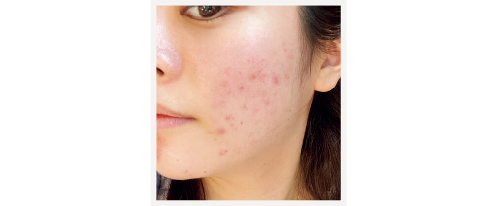 ニキビに悩む昔のももちさん