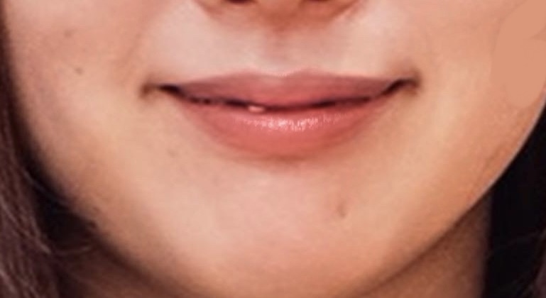 ワイヤー矯正 16ヶ月（１年４ヶ月）後