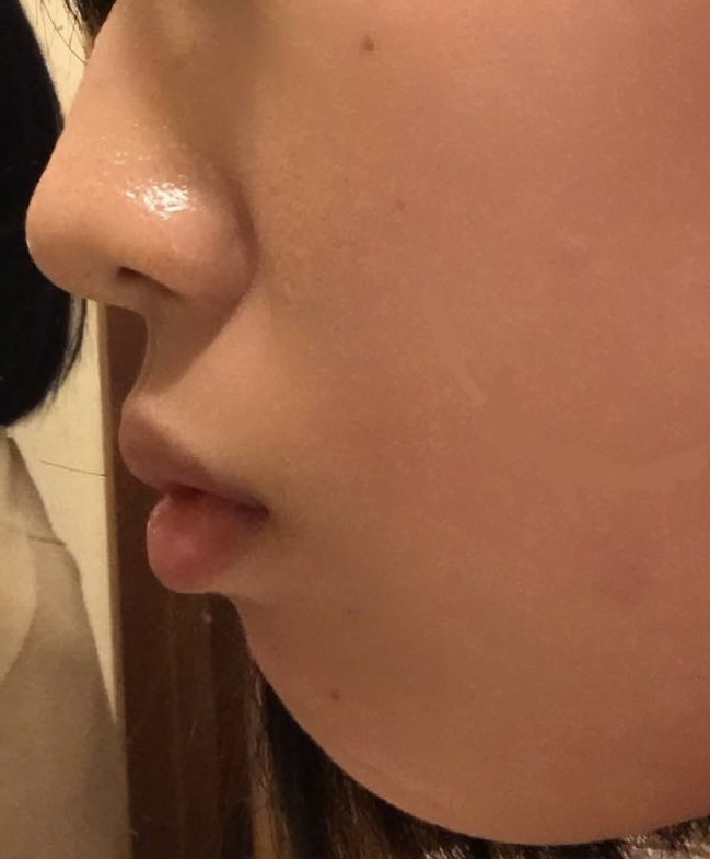 ワイヤー矯正 ３ヶ月後