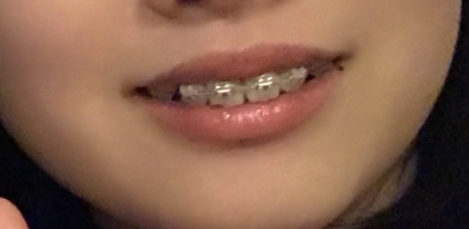 ワイヤー矯正 ３ヶ月後