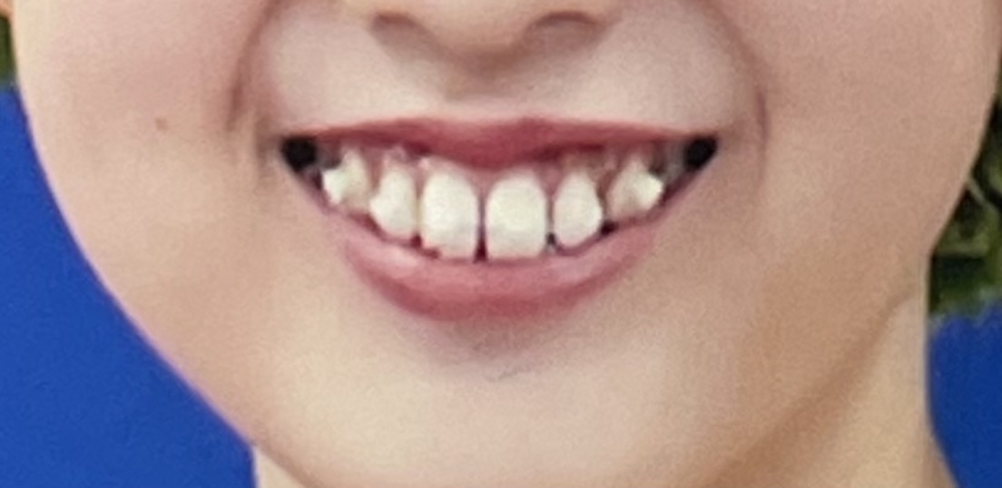 ワイヤー矯正 12ヶ月（１年）後