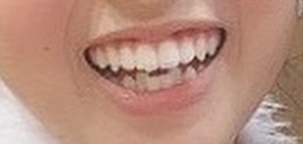 高２ ワイヤー矯正前