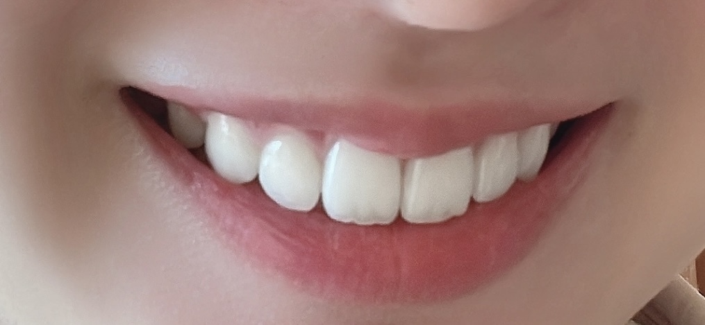 ワイヤー矯正終了後 現在