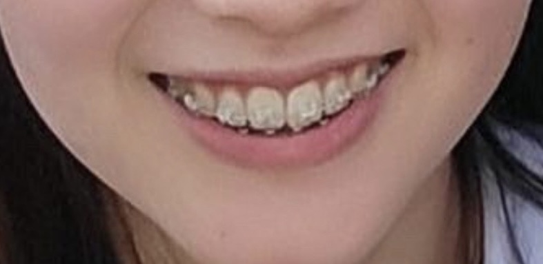 ワイヤー矯正 24ヶ月（２年）後