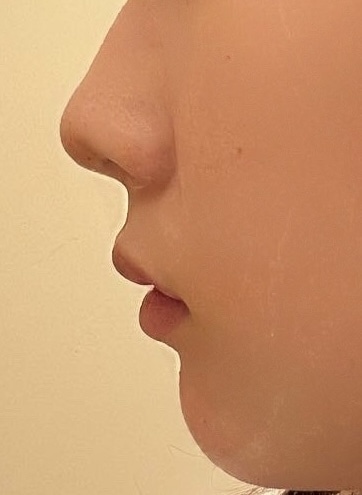 ワイヤー矯正 20ヶ月（１年８ヶ月）後