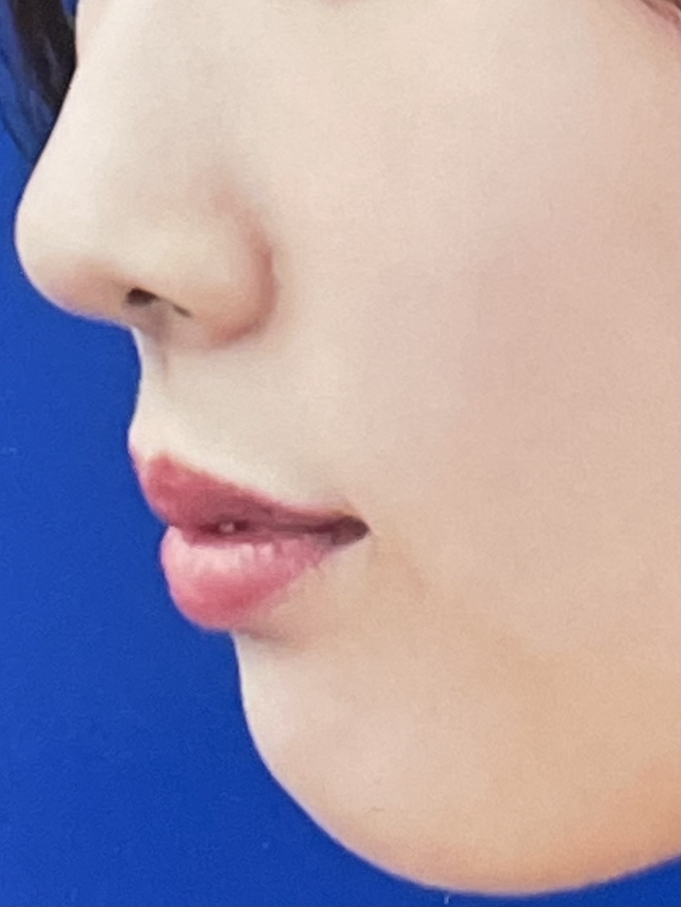 ワイヤー矯正 12ヶ月（１年）後