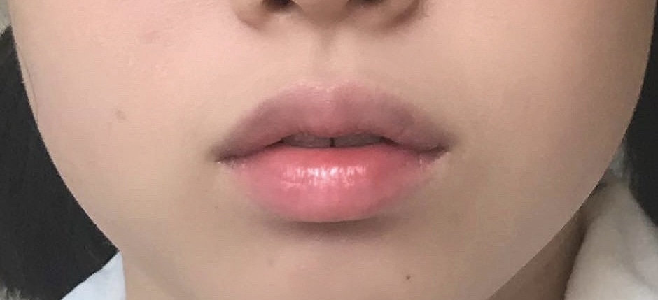 ワイヤー矯正 １ヶ月後