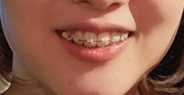 ワイヤー矯正 16ヶ月（１年４ヶ月）後