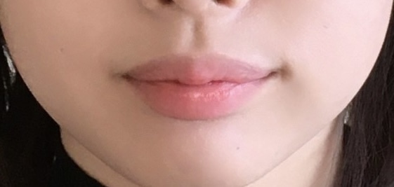 ワイヤー矯正 ６ヶ月後